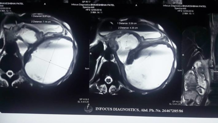 Endoscopic Ultrasound (EUS)