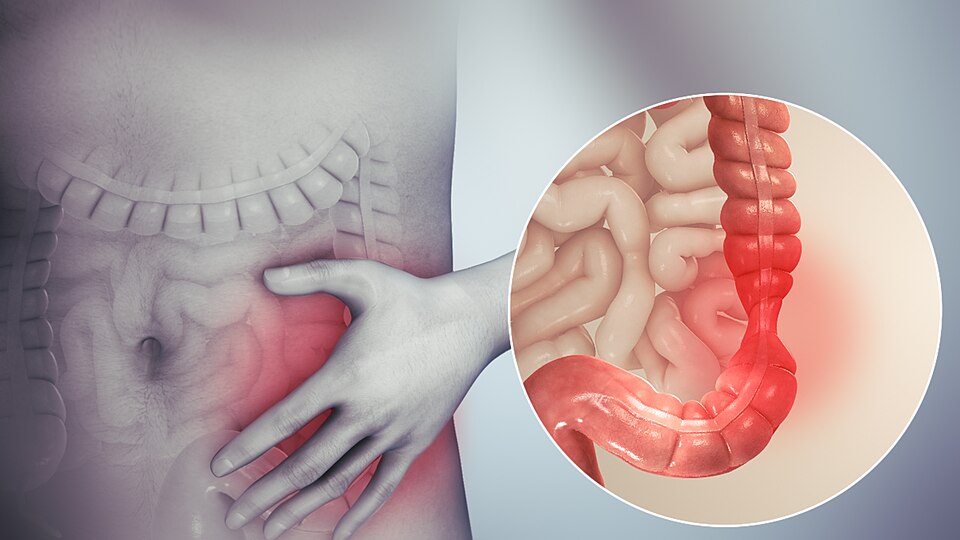 Living Comfortably with IBS: Advanced Irritable Bowel Syndrome Care in Ahmedabad