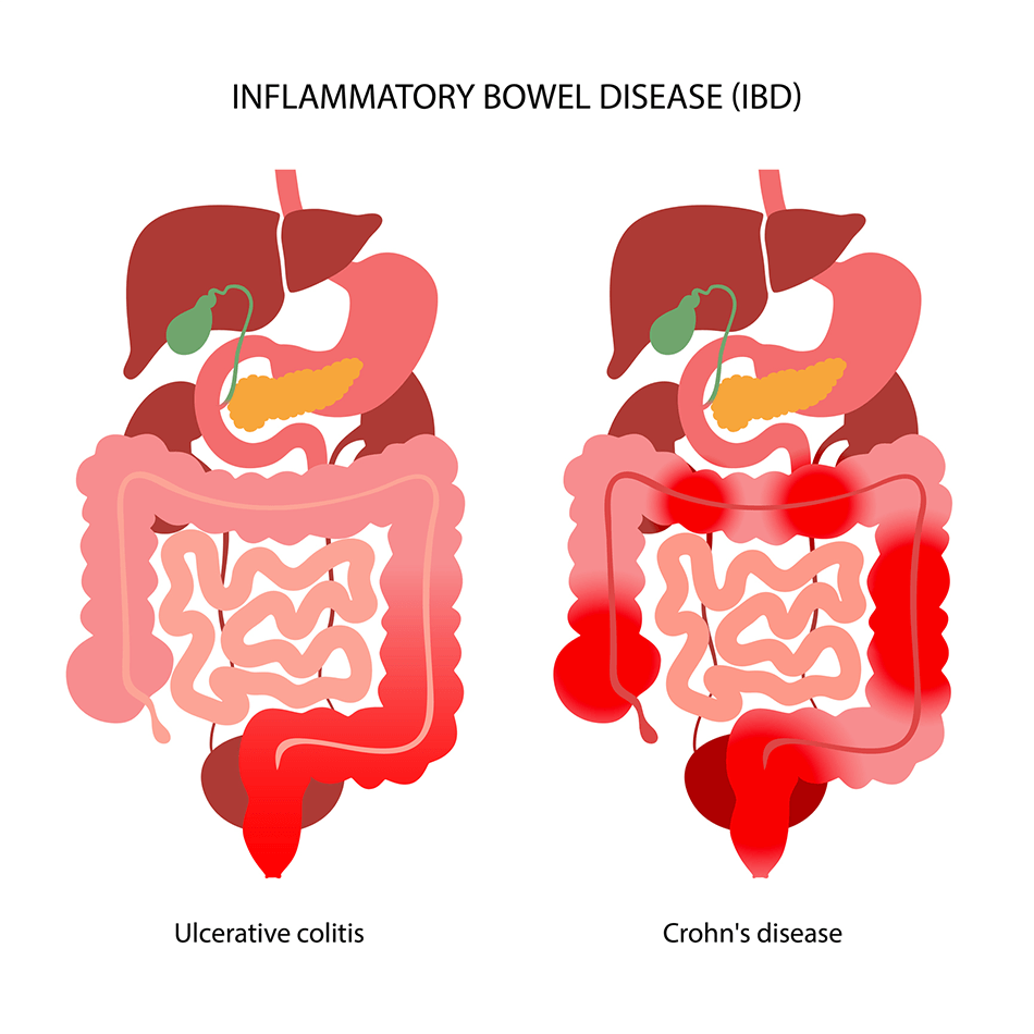Inflammatory Bowel Disease (IBD): Expert Care at Noble Gastro & Liver Hospital, Ahmedabad